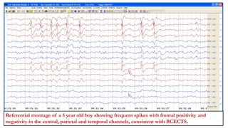 Referential montage of a 5 year old boy showing frequent spikes with frontal positivity and
negativity in the central, parietal and temporal channels, consistent with BCECTS.
 