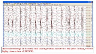 Referential montage of the same child showing marked activation of the spikes in sleep, which is
highly characteristic of BCECTS.
 
