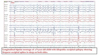 Longitudinal bipolar montage of a 9 year old child with idiopathic occipital epilepsy showing
frequent occipital spikes in sleep on both sides.
 