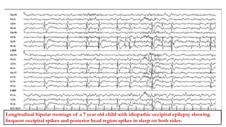 Longitudinal bipolar montage of a 7 year old child with idiopathic occipital epilepsy showing
frequent occipital spikes and posterior head region spikes in sleep on both sides.
 