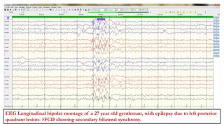 RAKSA KHATUN(4486610)
Left posterior quadrant epileptogenic focus with secondary bilateral synchrony.
EEG Longitudinal bipolar montage of a 27 year old gentleman, with epilepsy due to left posterior
quadrant lesion- ?FCD showing secondary bilateral synchrony.
 