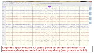 BRINDALEKSHMI(1887634)
Bifrontal intermittent slow activity.
Longitudinal bipolar montage of a 26 year old girl with one episode of unwitnessed loss of
consciousness, showing intermittent frontal delta range slowing (more prominent on the left).
 