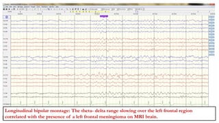BRINDALEKSHMI(1887634)
Bifrontal intermittent slow activity.
Longitudinal bipolar montage: The theta- delta range slowing over the left frontal region
correlated with the presence of a left frontal meningioma on MRI brain.
 