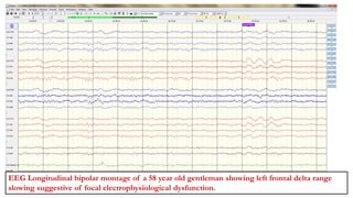 LAKSHMI NARAYAN (1801362)
LEFT FT SLOWING
EEG Longitudinal bipolar montage of a 58 year old gentleman showing left frontal delta range
slowing suggestive of focal electrophysiological dysfunction.
 