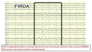 EEG Longitudinal bipolar montage bilateral frontal intermittent rhythmic delta activity (FIRDA).
This patient also had metabolic encephalopathy.
 