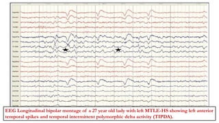 EEG Longitudinal bipolar montage of a 27 year old lady with left MTLE-HS showing left anterior
temporal spikes and temporal intermittent polymorphic delta activity (TIPDA).
 