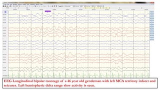 JAYARAJ M(1563225)
Left hemispheric slowing.
EEG Longitudinal bipolar montage of a 46 year old gentleman with left MCA territory infarct and
seizures. Left hemispheric delta range slow activity is seen.
 