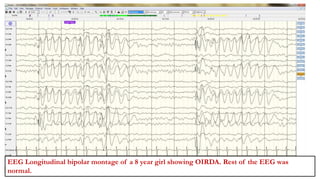 SAI APARNA(2272689)OIRDA
EEG Longitudinal bipolar montage of a 8 year girl showing OIRDA. Rest of the EEG was
normal.
 