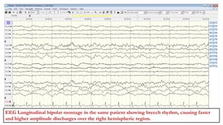 EEG Longitudinal bipolar montage in the same patient showing breech rhythm, causing faster
and higher amplitude discharges over the right hemispheric region.
 