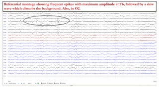 Referential montage showing frequent spikes with maximum amplitude at T6, followed by a slow
wave which disturbs the background. Also, in O2.
 