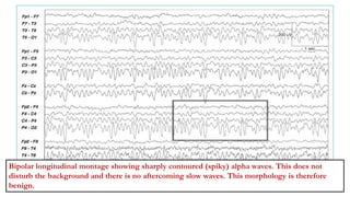 Bipolar longitudinal montage showing sharply contoured (spiky) alpha waves. This does not
disturb the background and there is no aftercoming slow waves. This morphology is therefore
benign.
 