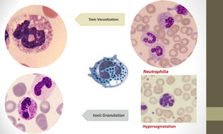 Toxic Vacuolization
toxic Granulation
Neutrophilia
Hypersegmetation
 