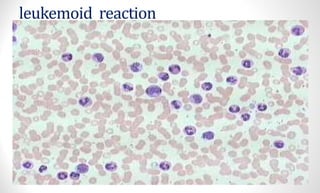 leukemoid reaction
 