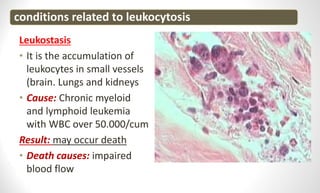 Leukostasis
• It is the accumulation of
leukocytes in small vessels
(brain. Lungs and kidneys
• Cause: Chronic myeloid
and lymphoid leukemia
with WBC over 50.000/cum
Result: may occur death
• Death causes: impaired
blood flow
conditions related to leukocytosis
 