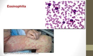 Eosinophilia
 