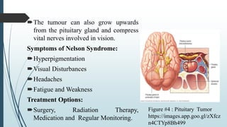 The tumour can also grow upwards
from the pituitary gland and compress
vital nerves involved in vision.
Symptoms of Nelson Syndrome:
Hyperpigmentation
Visual Disturbances
Headaches
Fatigue and Weakness
Treatment Options:
Surgery, Radiation Therapy,
Medication and Regular Monitoring.
Figure #4 : Pituitary Tumor
https://images.app.goo.gl/zXfcz
n4CTYp8Bh499
 