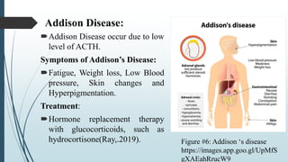 Addison Disease:
Addison Disease occur due to low
level of ACTH.
Symptoms of Addison’s Disease:
Fatigue, Weight loss, Low Blood
pressure, Skin changes and
Hyperpigmentation.
Treatment:
Hormone replacement therapy
with glucocorticoids, such as
hydrocortisone(Ray,.2019). Figure #6: Addison ‘s disease
https://images.app.goo.gl/UpMfS
gXAEahRrucW9
 