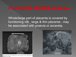 Whole/large part of placenta is covered by
functioning villi , large & thin placenta ; may
be associated with praevia or accereta.
 
