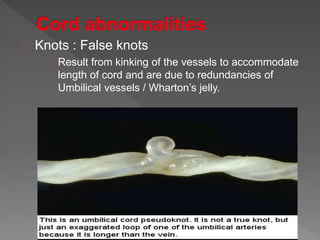 Knots : False knots
Result from kinking of the vessels to accommodate
length of cord and are due to redundancies of
Umbilical vessels / Wharton’s jelly.
 