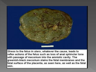 Abnormalities of cord & placenta