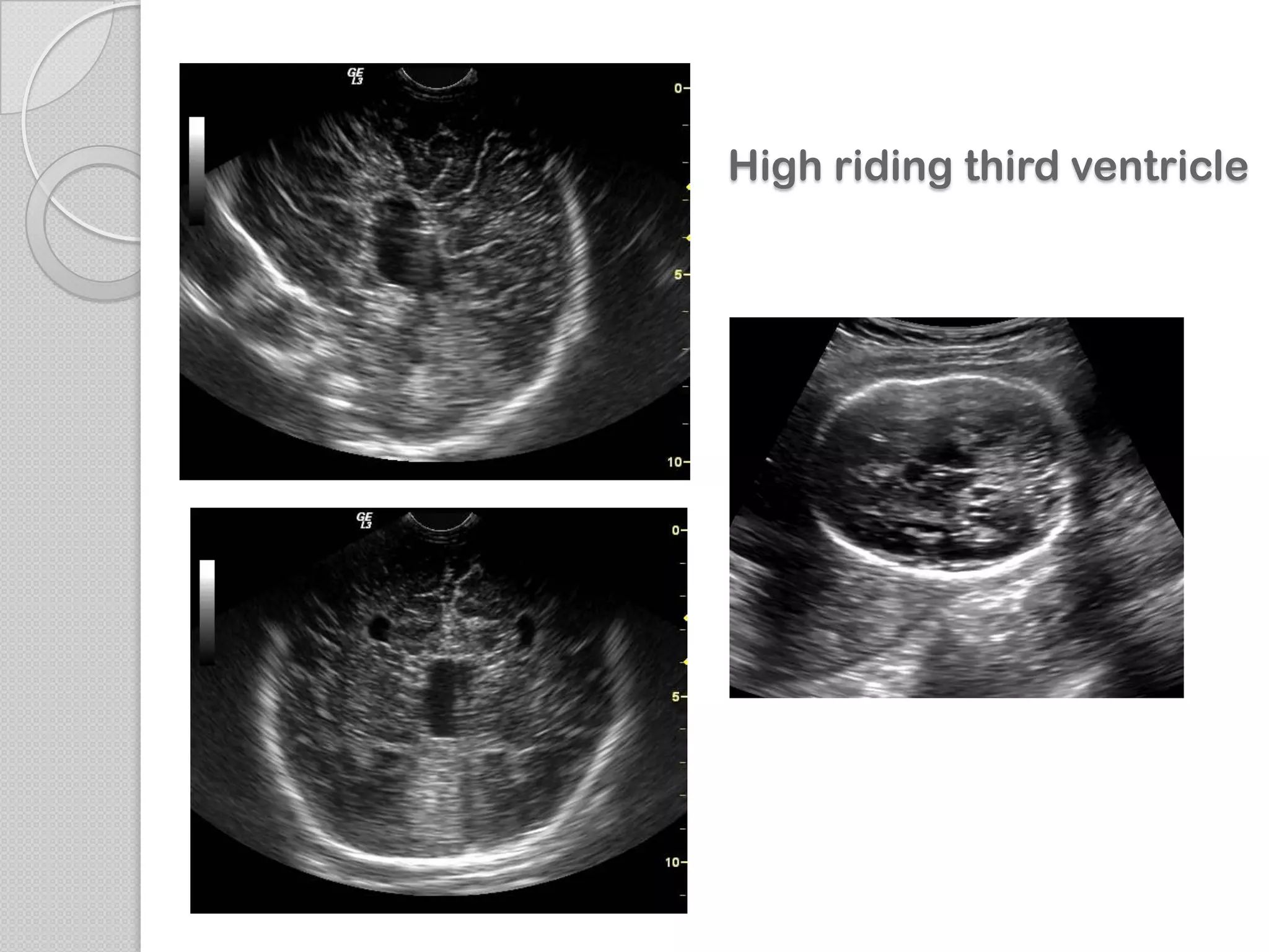 High riding third ventricle
 