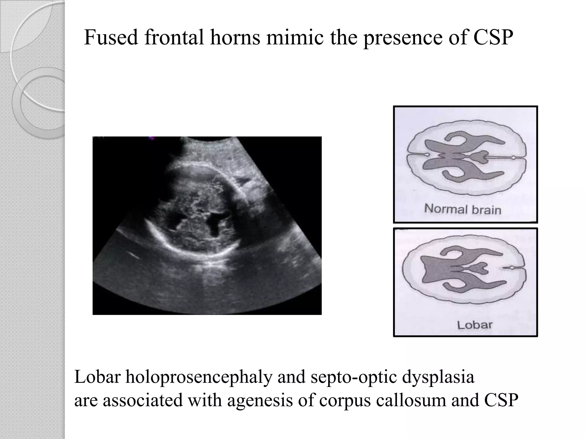 Fused frontal horns mimic the presence of CSP
Lobar holoprosencephaly and septo-optic dysplasia
are associated with agenesis of corpus callosum and CSP
 