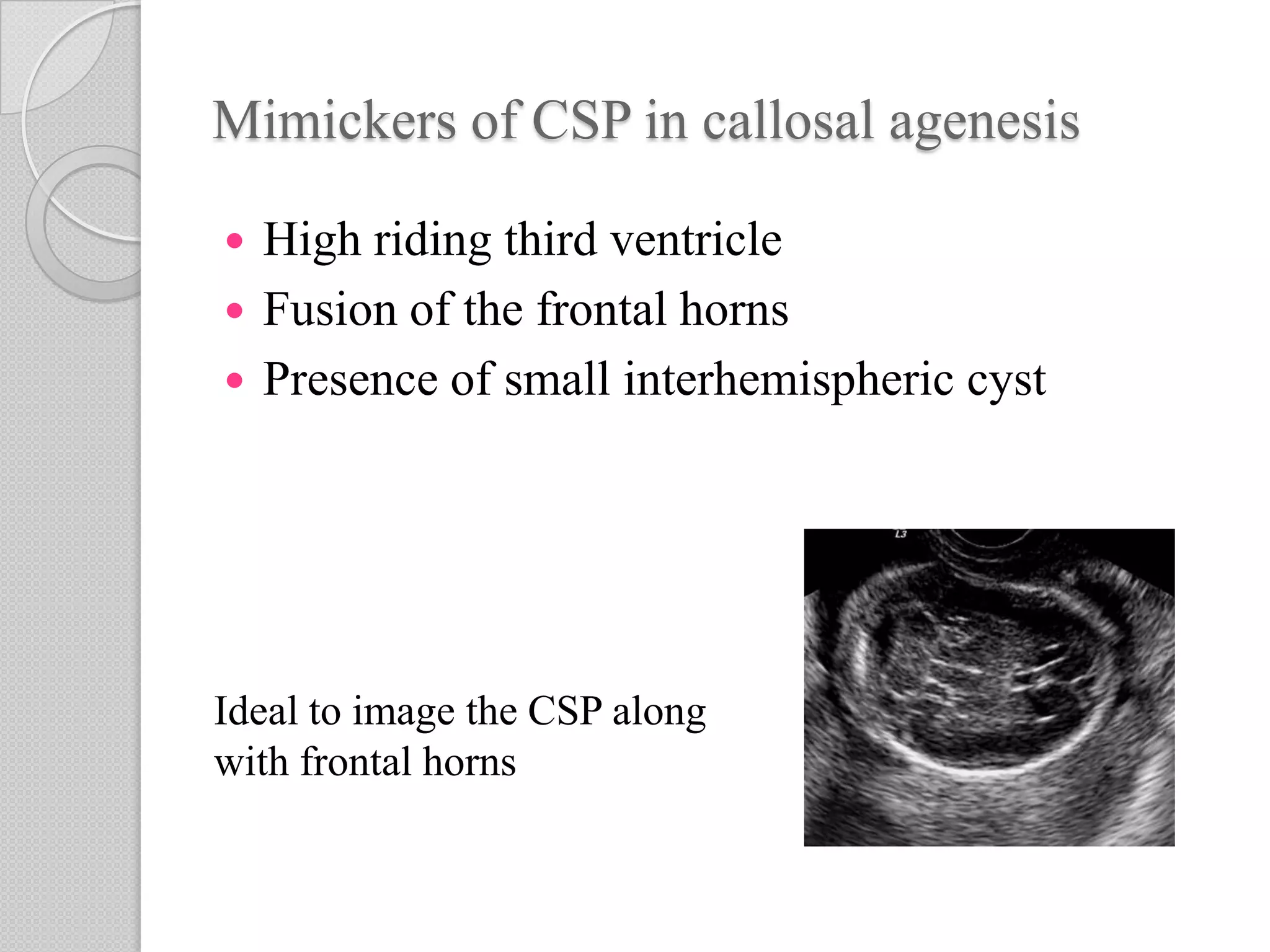 Mimickers of CSP in callosal agenesis
 High riding third ventricle
 Fusion of the frontal horns
 Presence of small interhemispheric cyst
Ideal to image the CSP along
with frontal horns
 