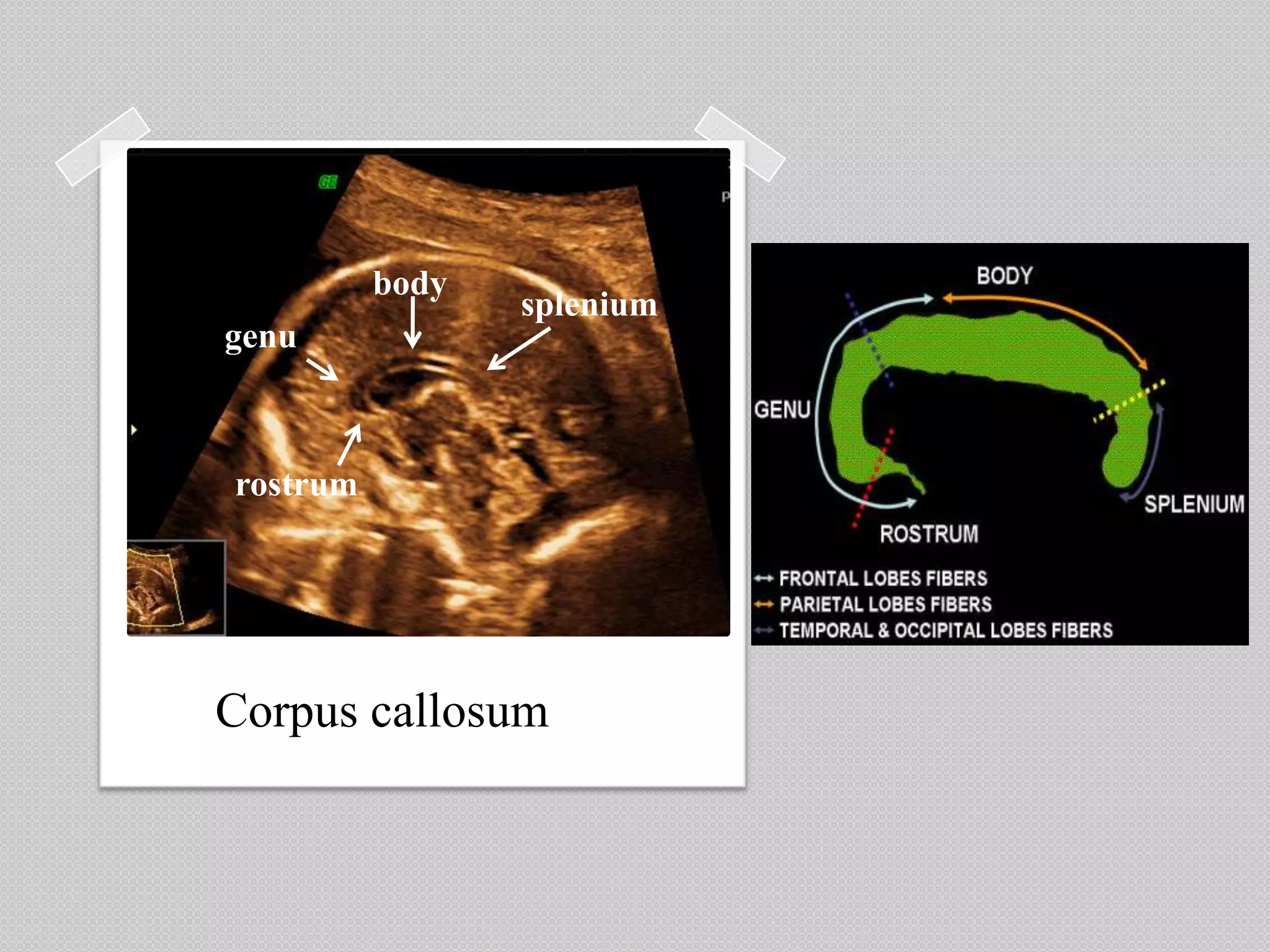 Corpus callosum
splenium
body
genu
rostrum
 
