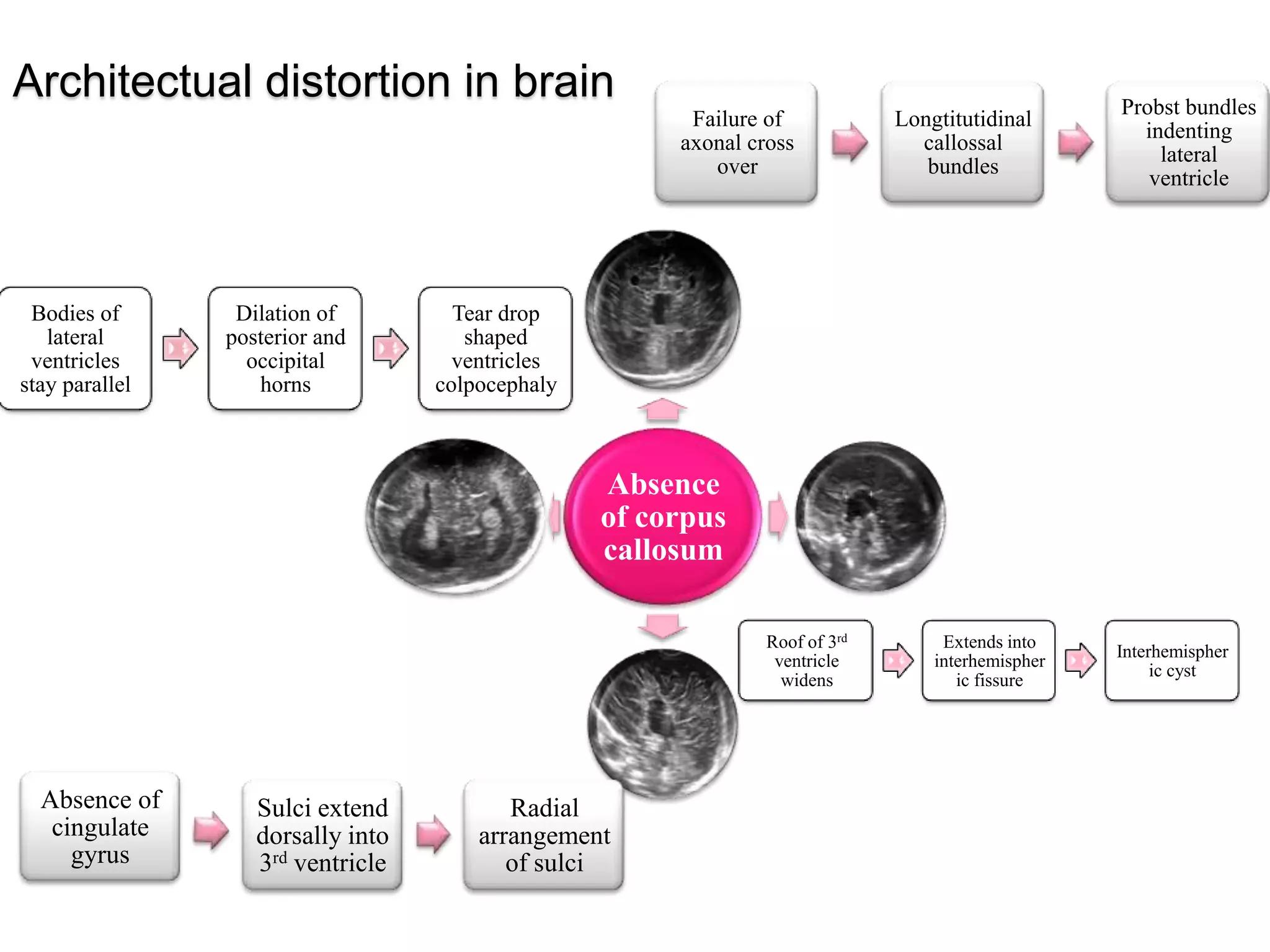 Absence
of corpus
callosum
Failure of
axonal cross
over
Longtitutidinal
callossal
bundles
Probst bundles
indenting
lateral
ventricle
Absence of
cingulate
gyrus
Sulci extend
dorsally into
3rd ventricle
Radial
arrangement
of sulci
Roof of 3rd
ventricle
widens
Extends into
interhemispher
ic fissure
Interhemispher
ic cyst
Bodies of
lateral
ventricles
stay parallel
Dilation of
posterior and
occipital
horns
Tear drop
shaped
ventricles
colpocephaly
Architectual distortion in brain
 