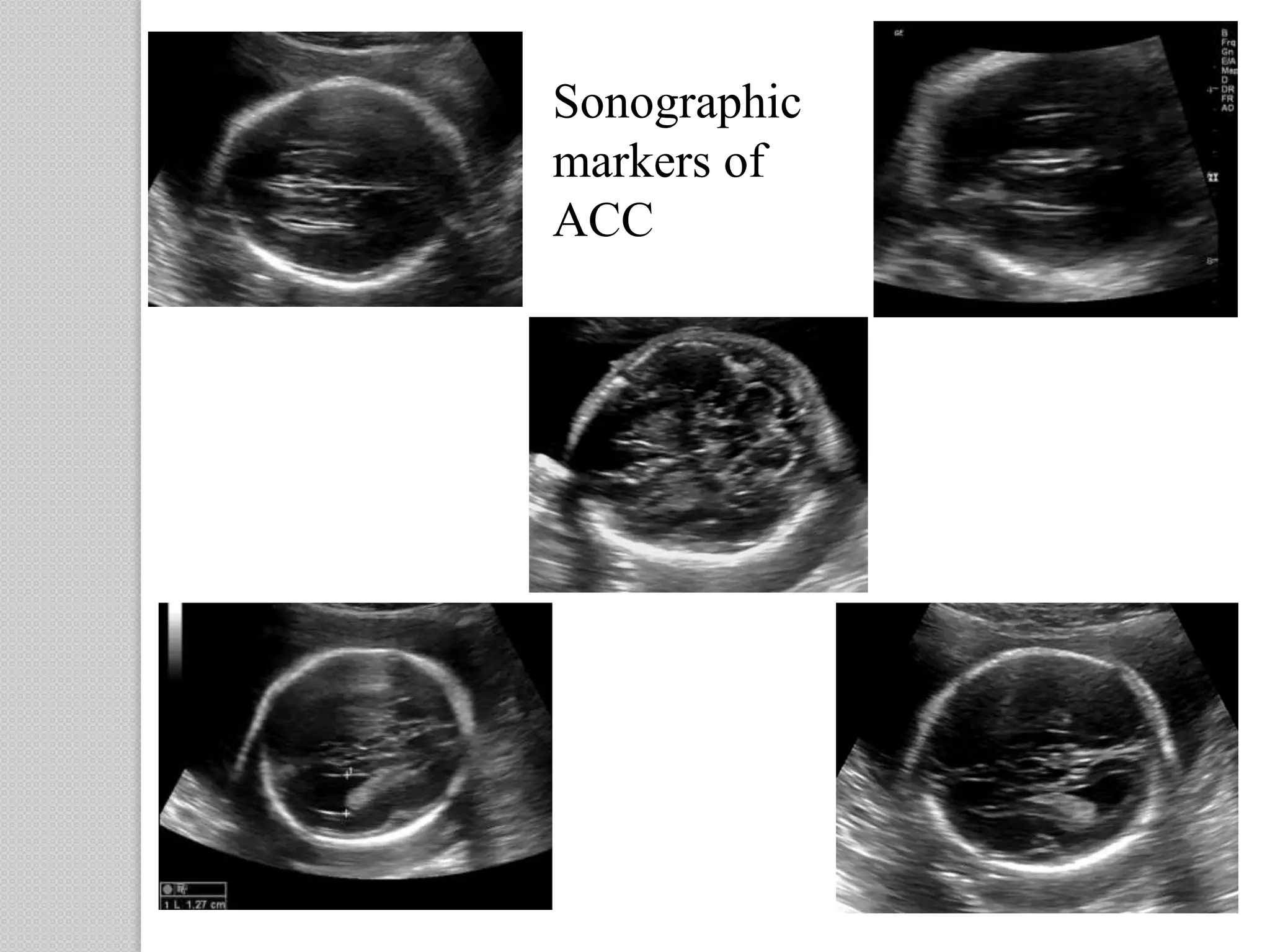 Sonographic
markers of
ACC
 