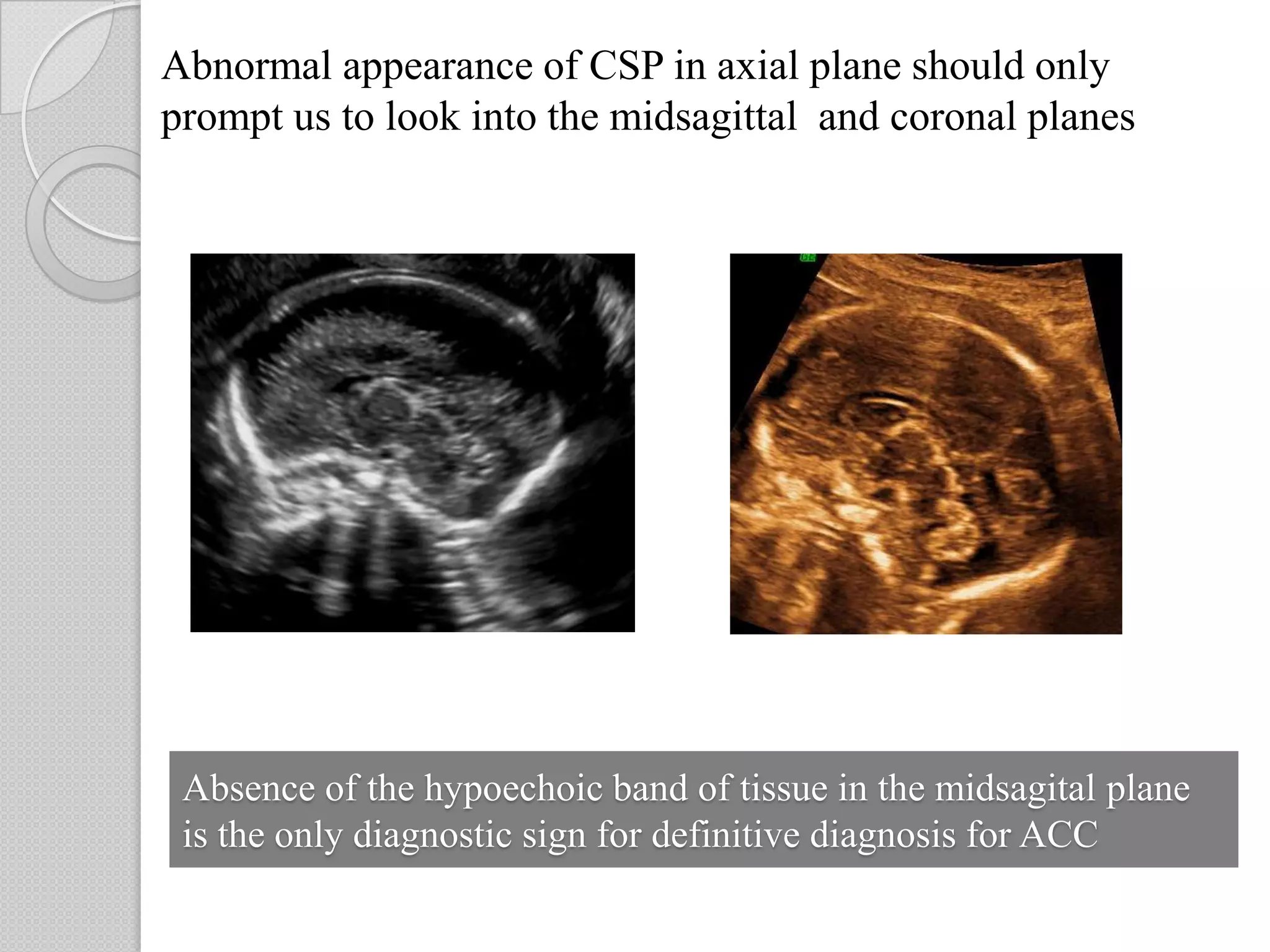 Absence of the hypoechoic band of tissue in the midsagital plane
is the only diagnostic sign for definitive diagnosis for ACC
Abnormal appearance of CSP in axial plane should only
prompt us to look into the midsagittal and coronal planes
 