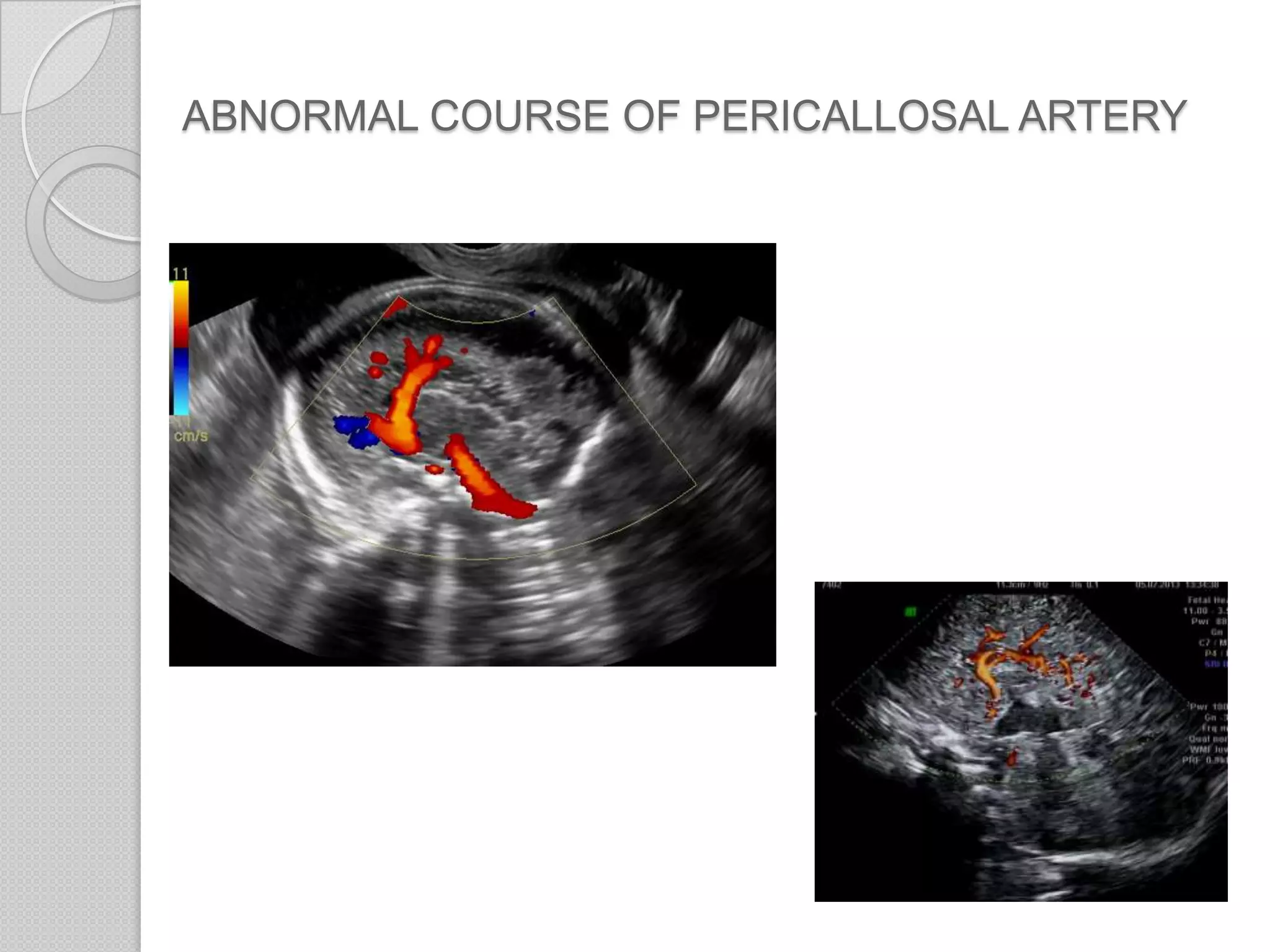 ABNORMAL COURSE OF PERICALLOSAL ARTERY
 