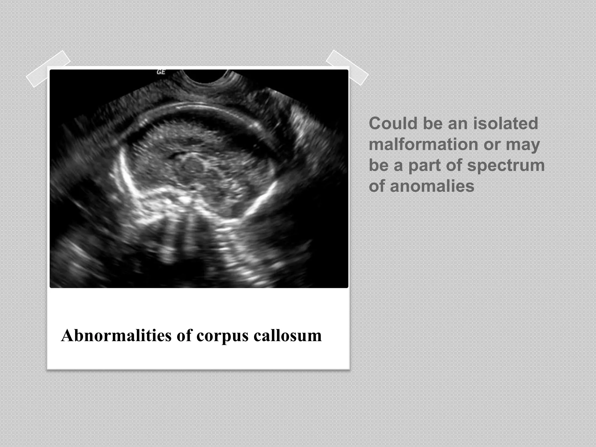 Could be an isolated
malformation or may
be a part of spectrum
of anomalies
Abnormalities of corpus callosum
 