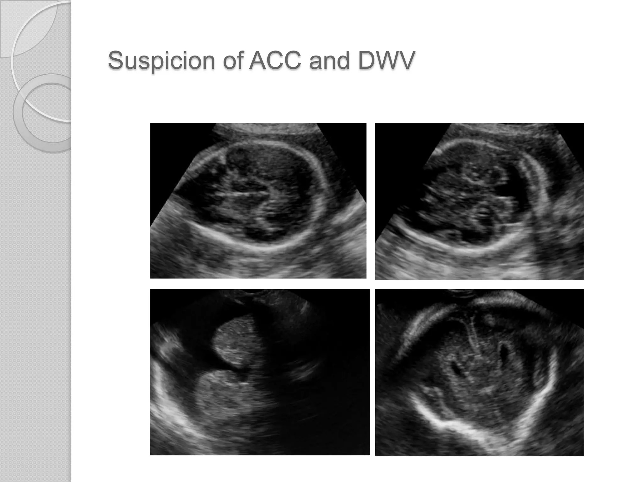Suspicion of ACC and DWV
 