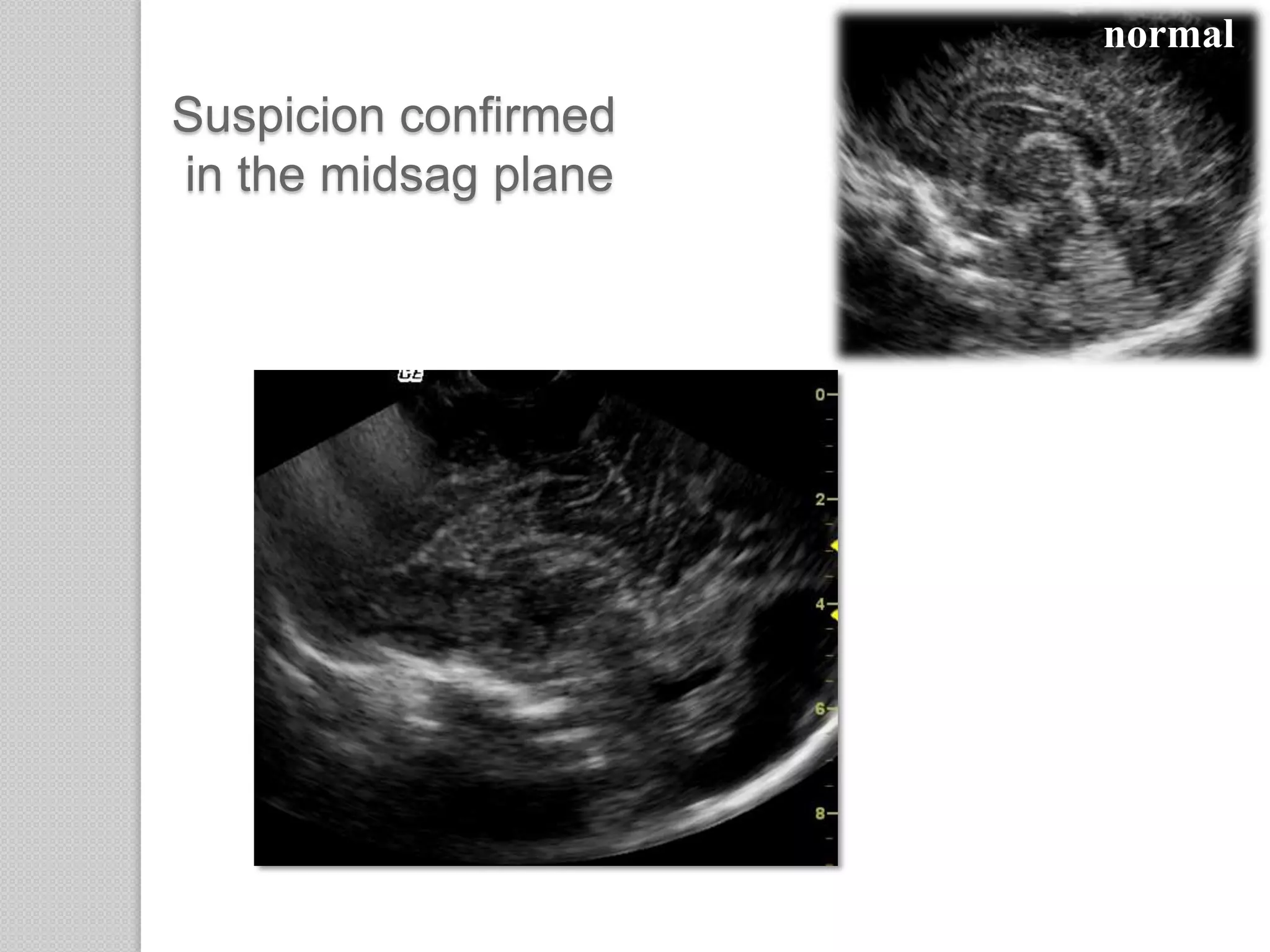 Suspicion confirmed
in the midsag plane
normal
 