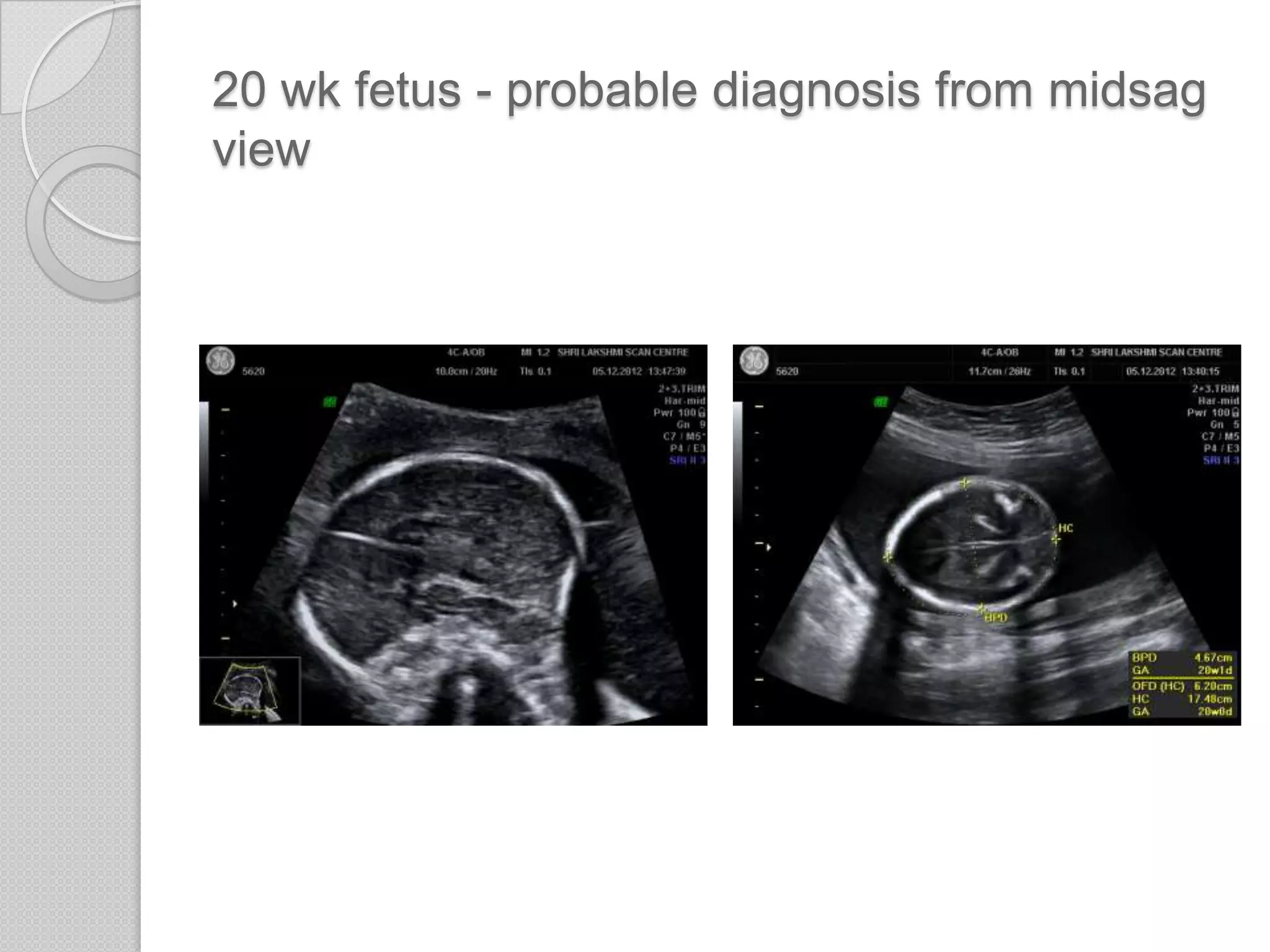20 wk fetus - probable diagnosis from midsag
view
 