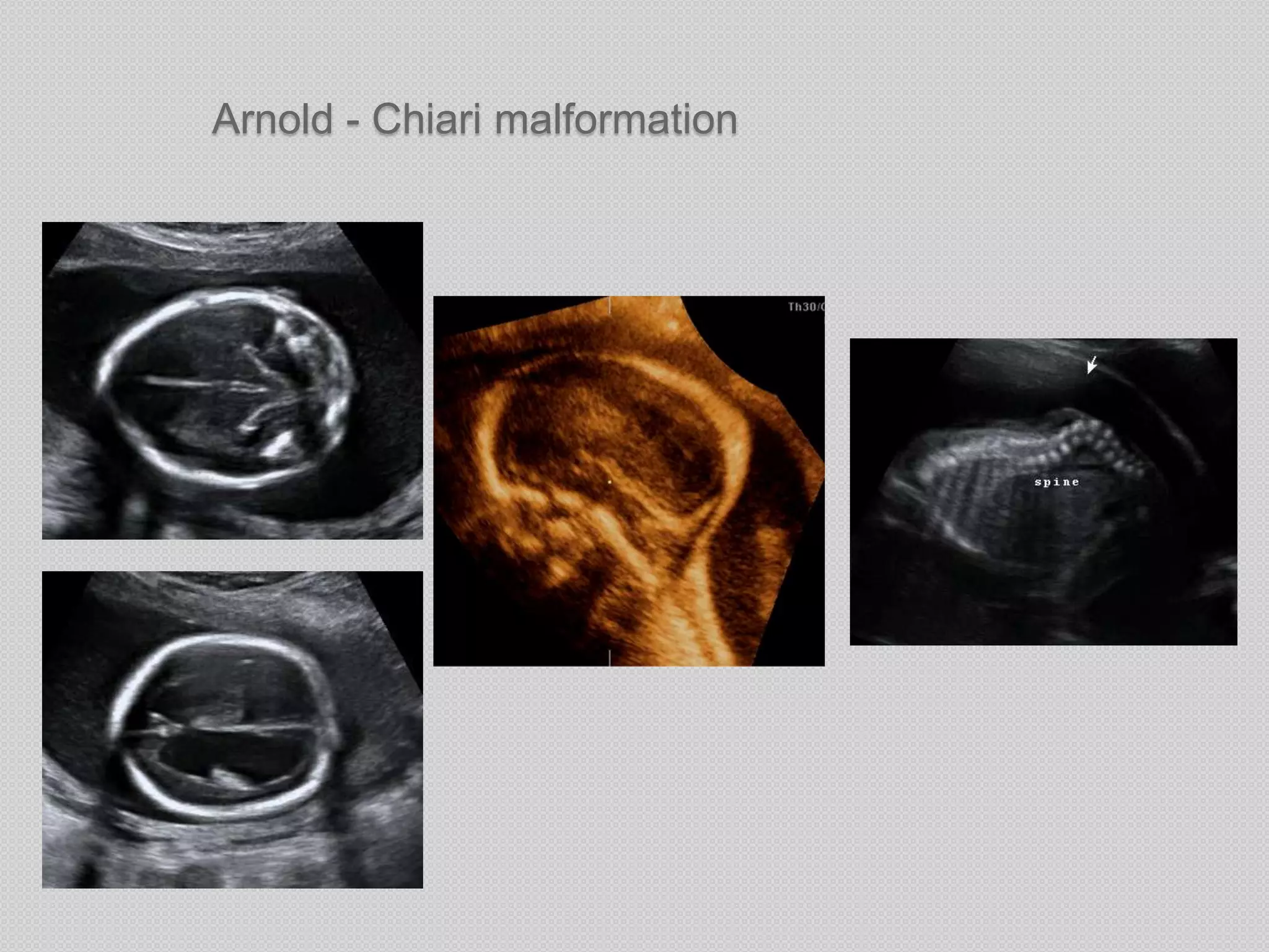 Arnold - Chiari malformation
 