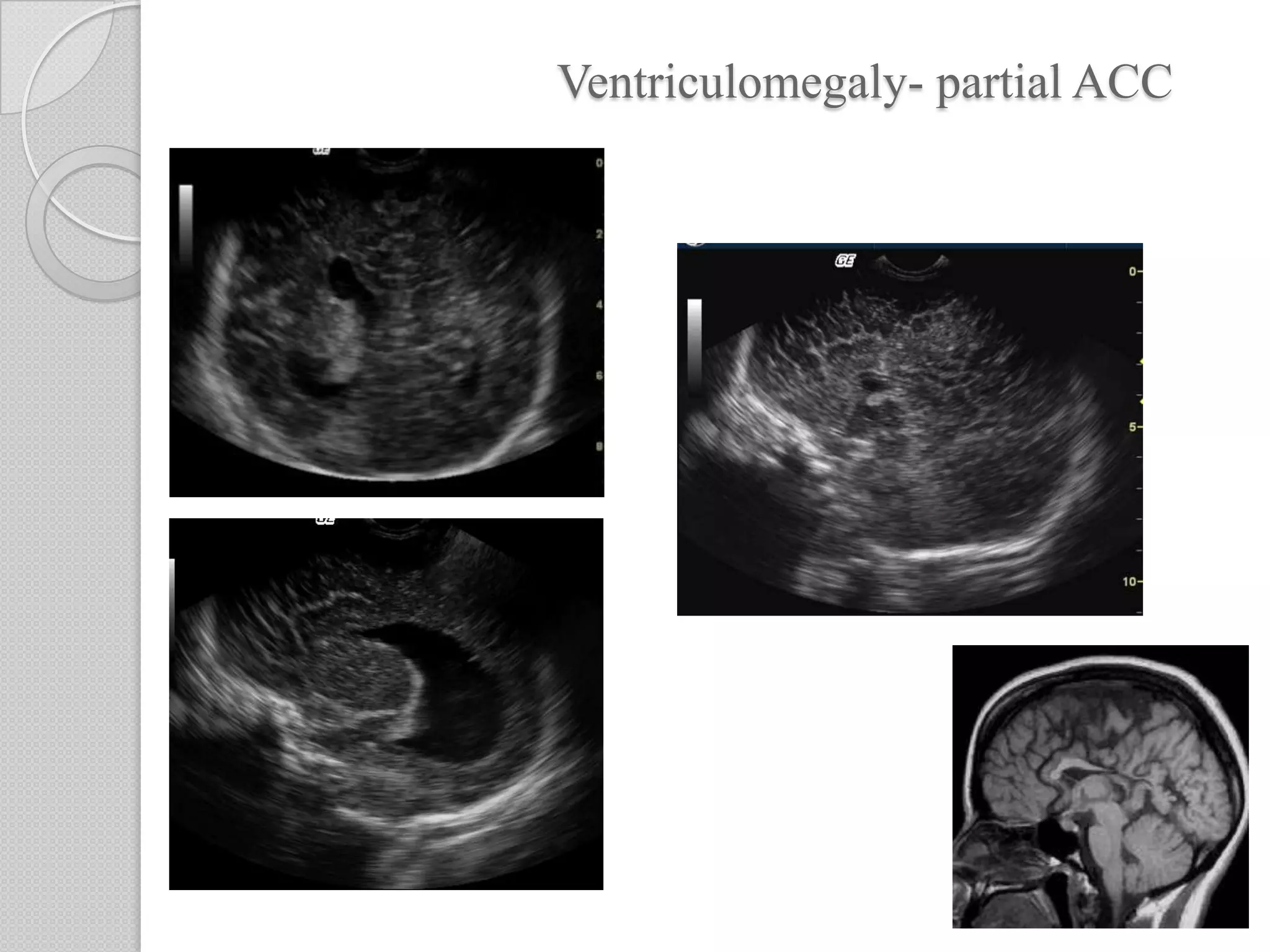 Ventriculomegaly- partial ACC
 
