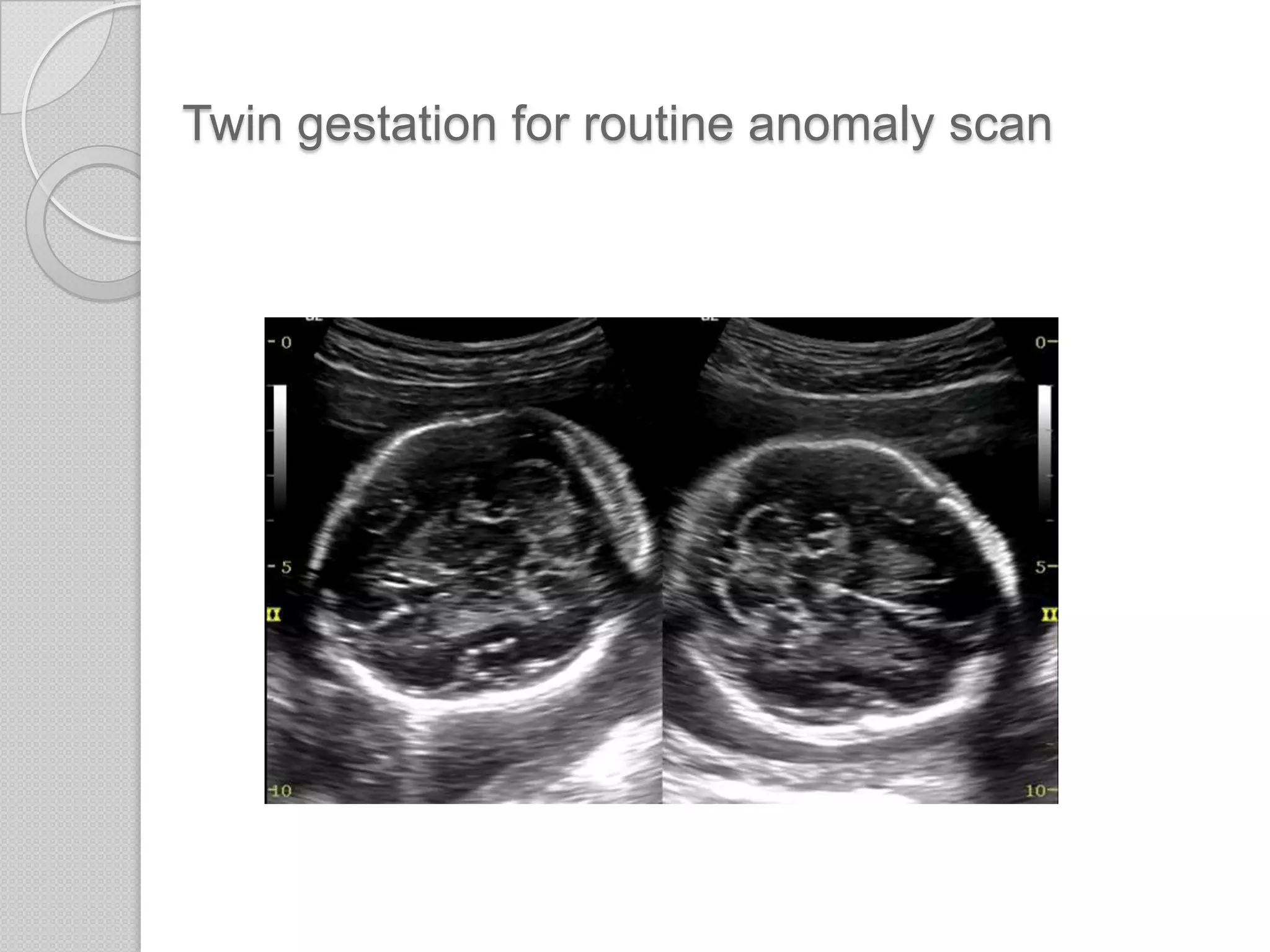 Twin gestation for routine anomaly scan
 