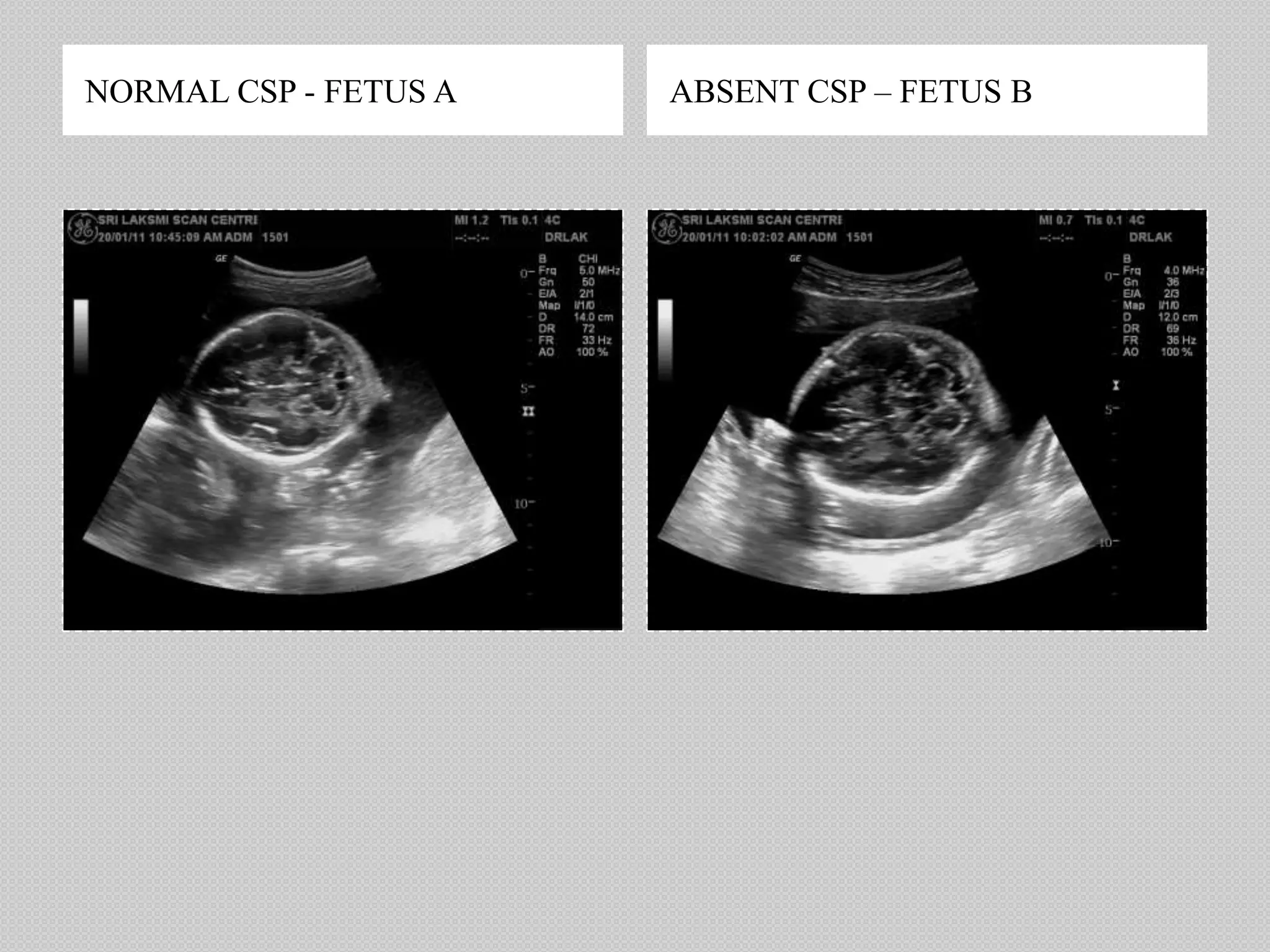 NORMAL CSP - FETUS A ABSENT CSP – FETUS B
 