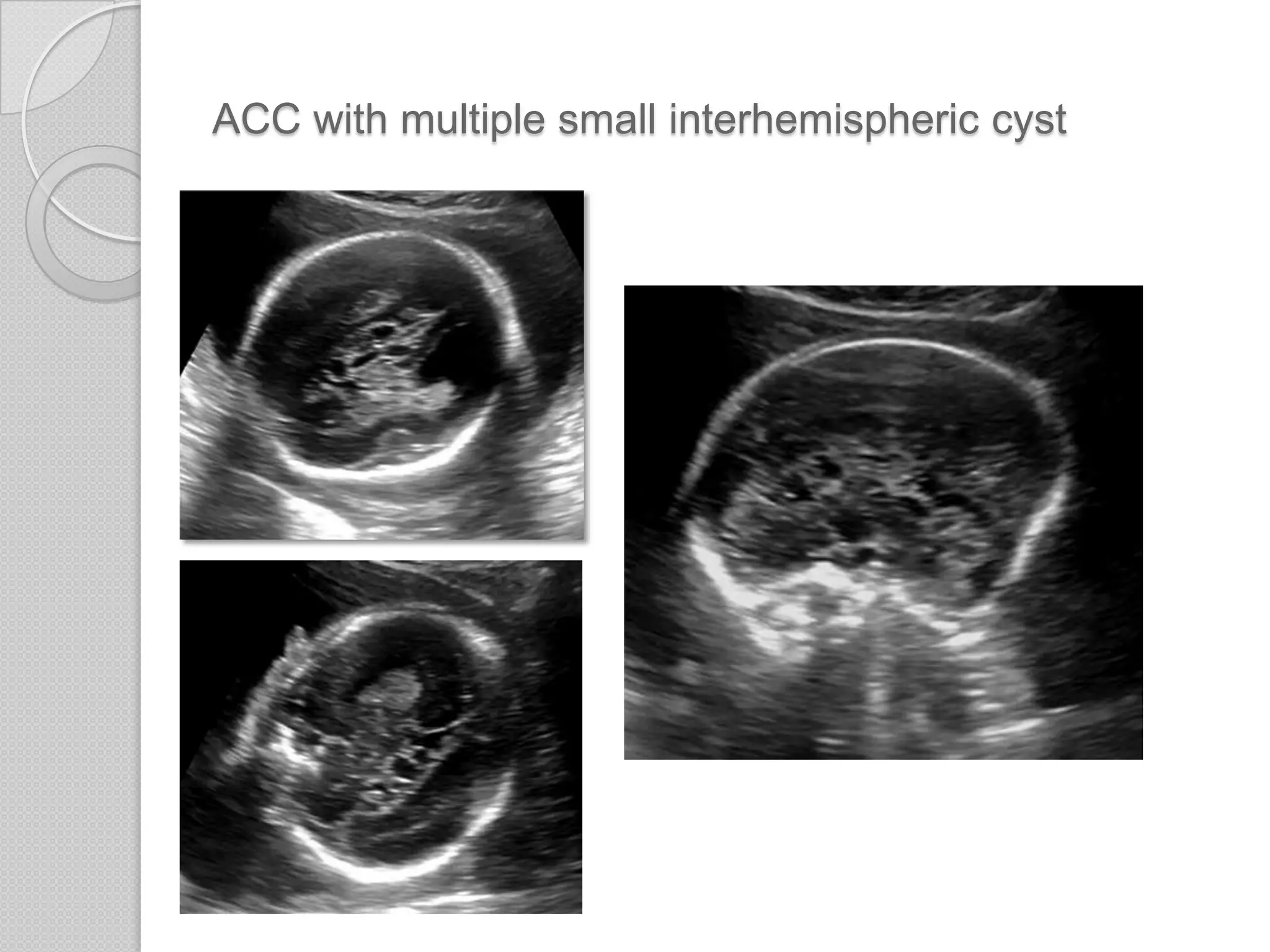 ACC with multiple small interhemispheric cyst
 
