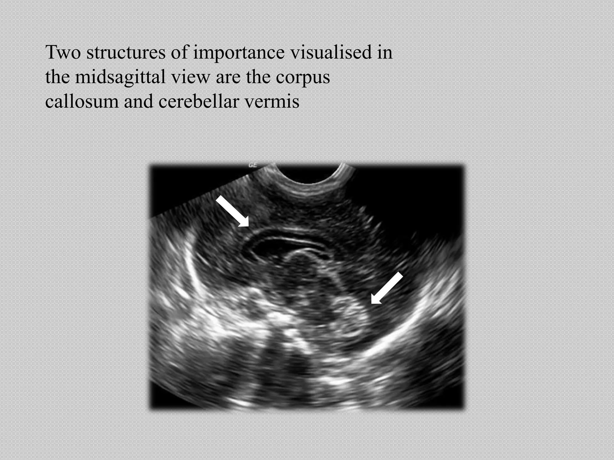 Two structures of importance visualised in
the midsagittal view are the corpus
callosum and cerebellar vermis
 