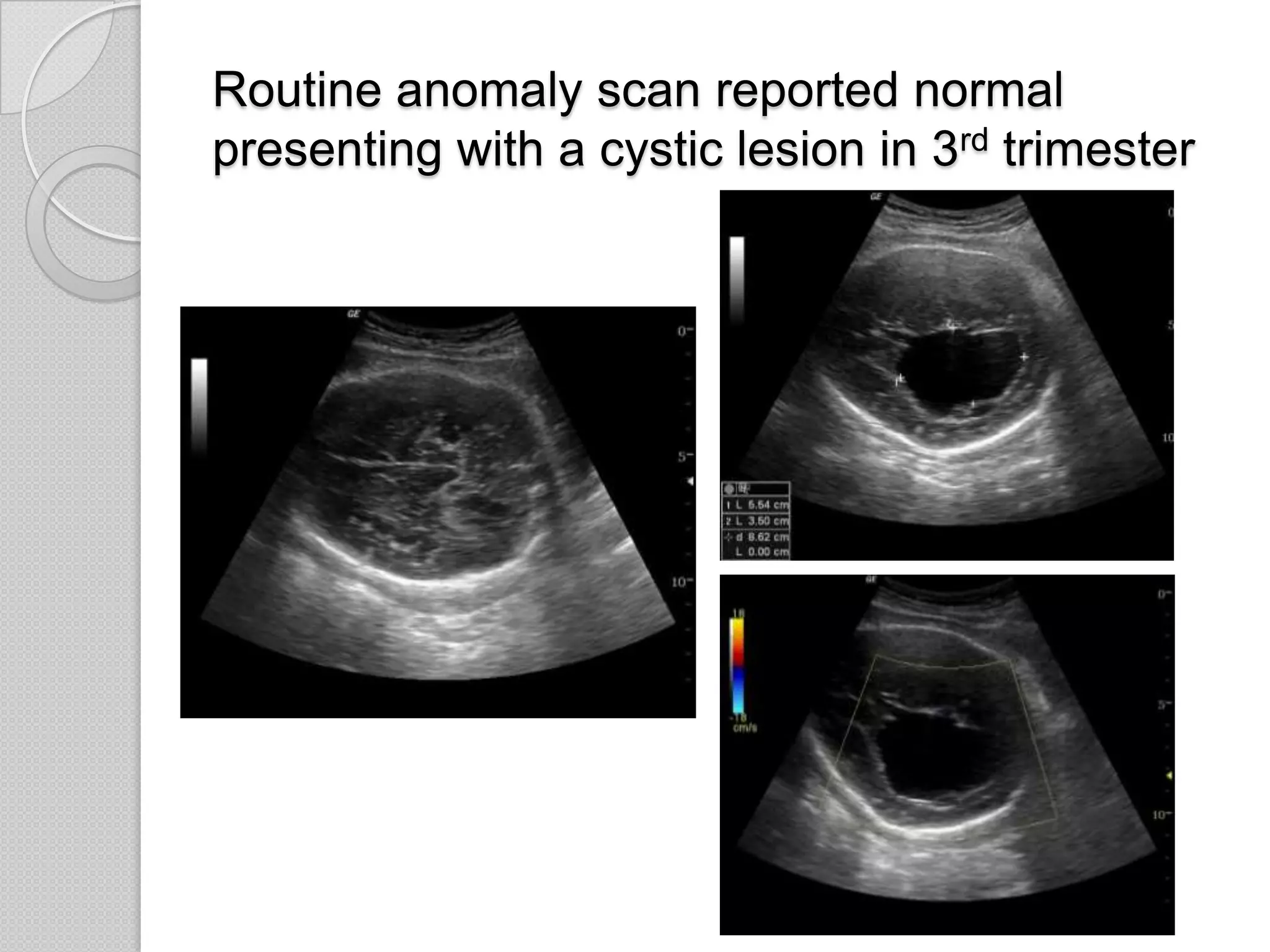 Routine anomaly scan reported normal
presenting with a cystic lesion in 3rd trimester
 