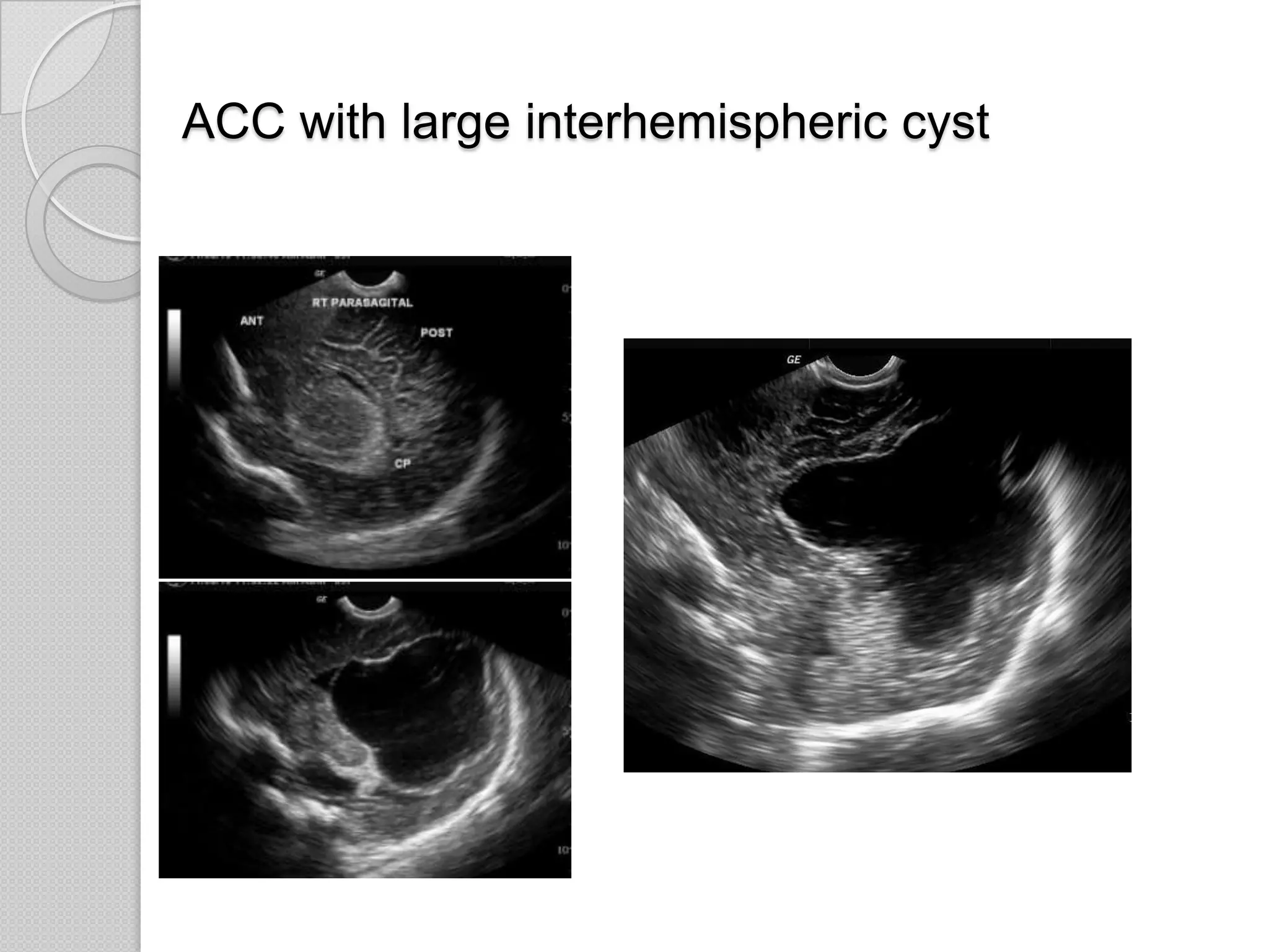 ACC with large interhemispheric cyst
 
