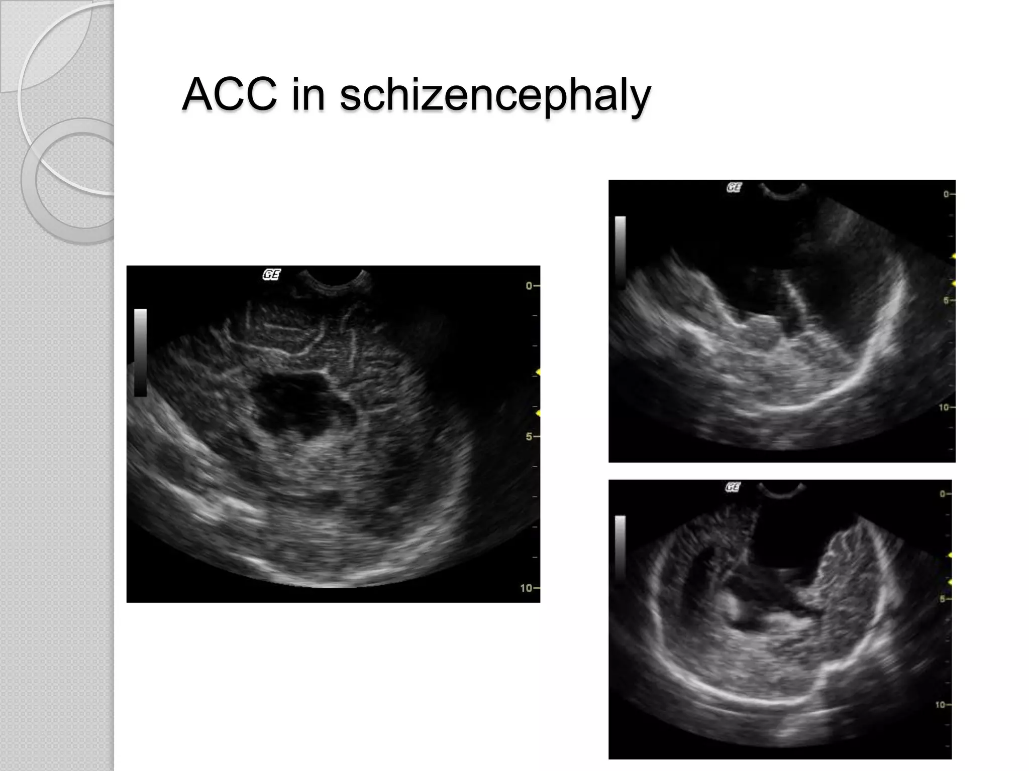 ACC in schizencephaly
 
