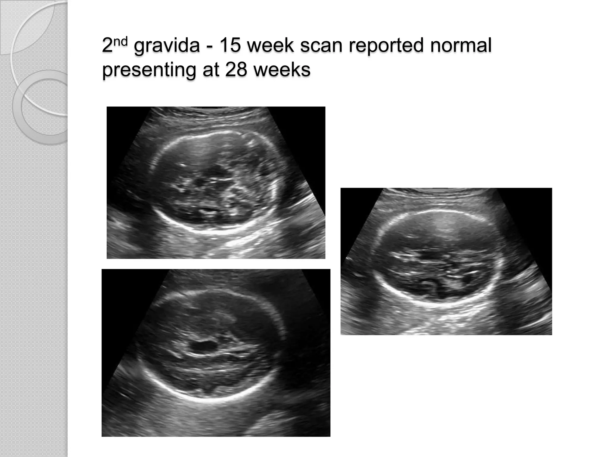 2nd gravida - 15 week scan reported normal
presenting at 28 weeks
 