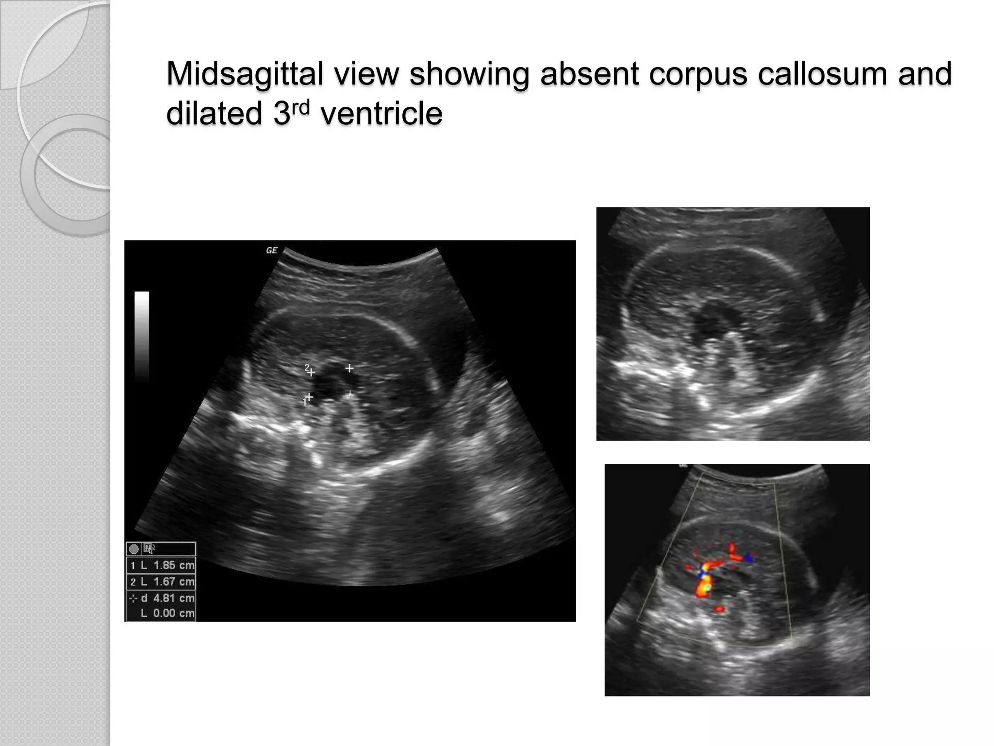 Midsagittal view showing absent corpus callosum and
dilated 3rd ventricle
 