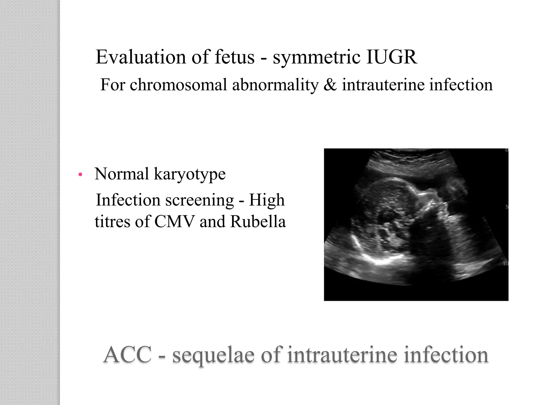 ACC - sequelae of intrauterine infection
• Normal karyotype
Infection screening - High
titres of CMV and Rubella
Evaluation of fetus - symmetric IUGR
For chromosomal abnormality & intrauterine infection
 