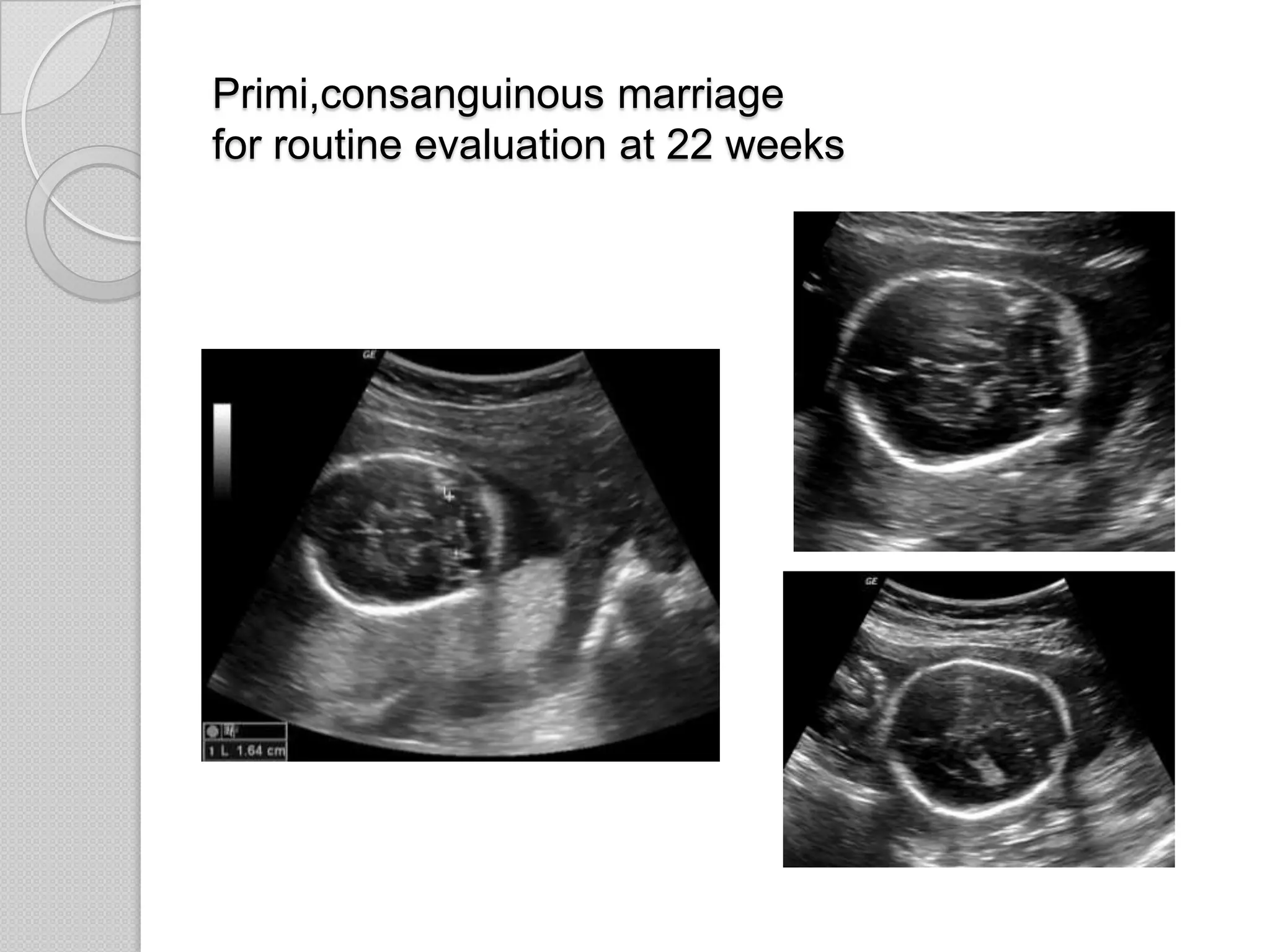 Primi,consanguinous marriage
for routine evaluation at 22 weeks
 