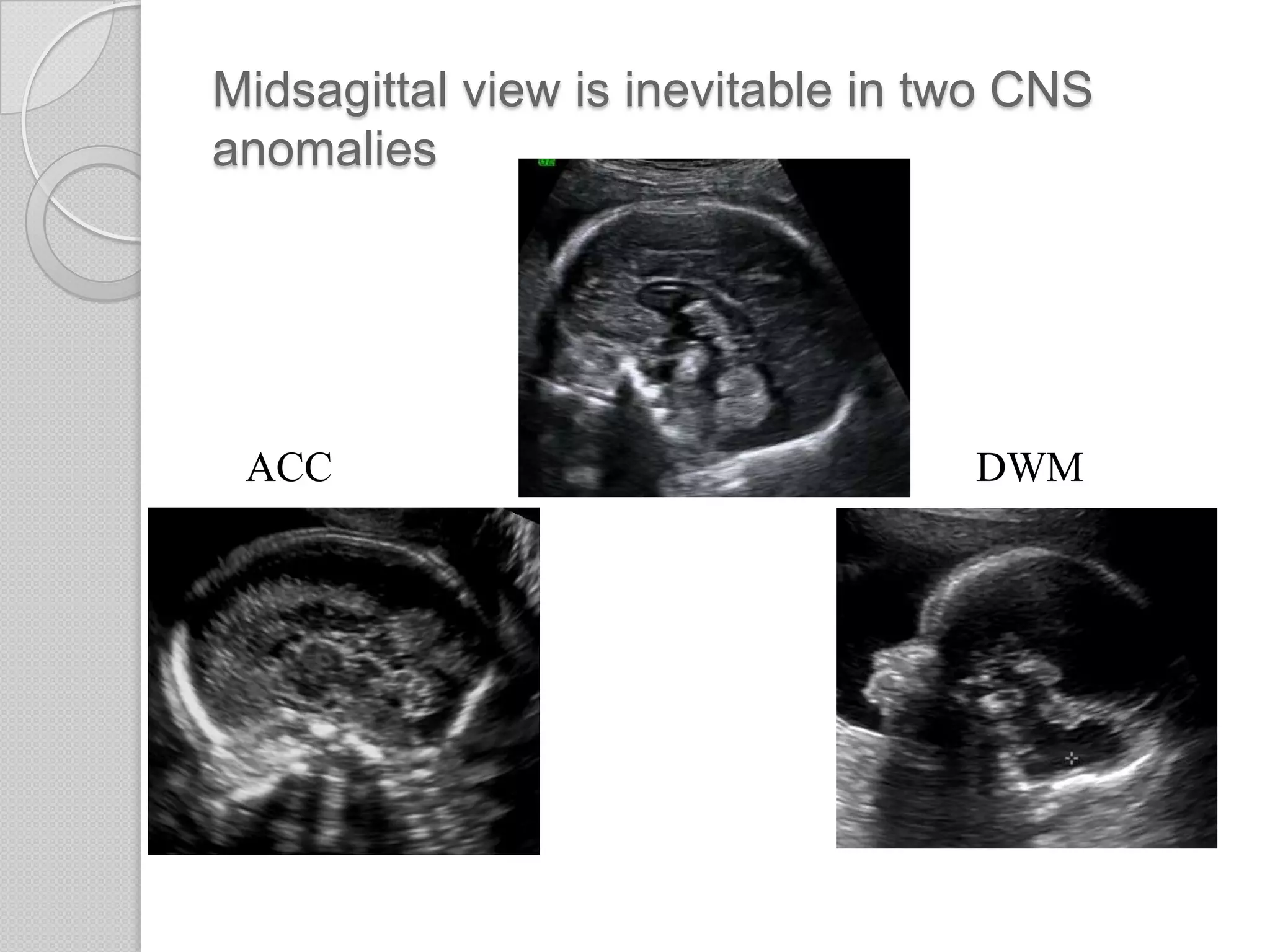 Midsagittal view is inevitable in two CNS
anomalies
ACC DWM
 